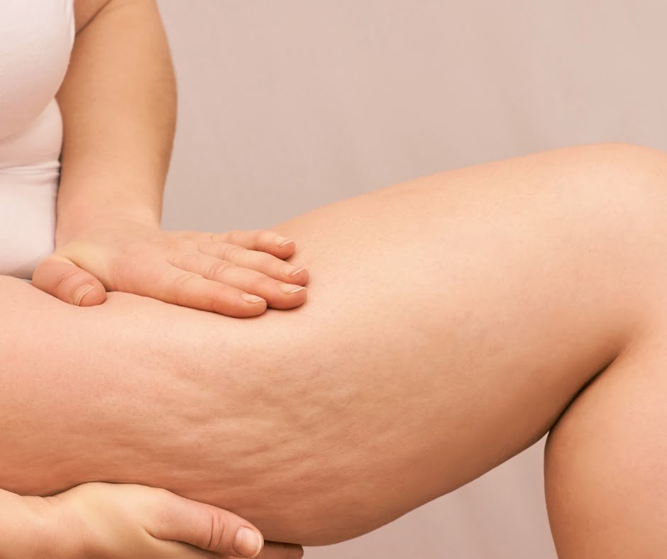 Aveli-Cellulite-Treatment