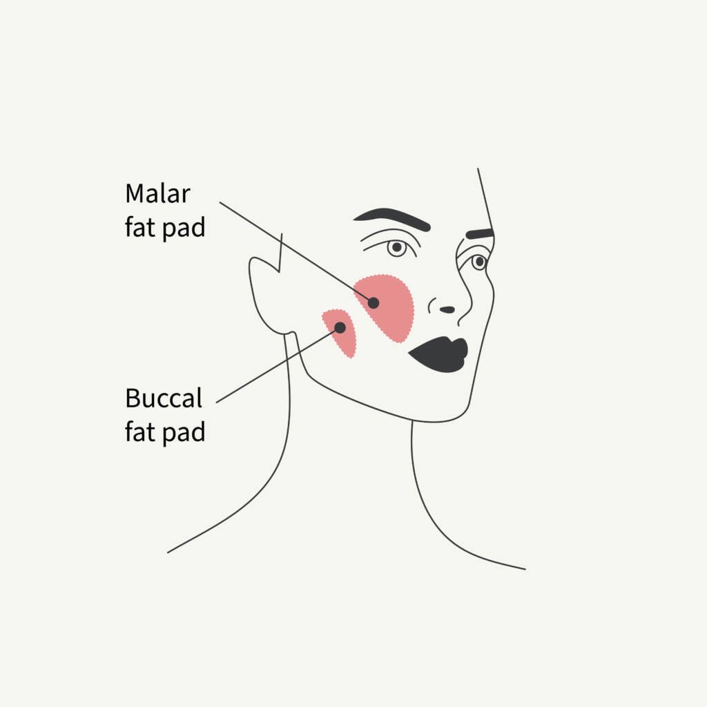 Buccal Fat Removal areas