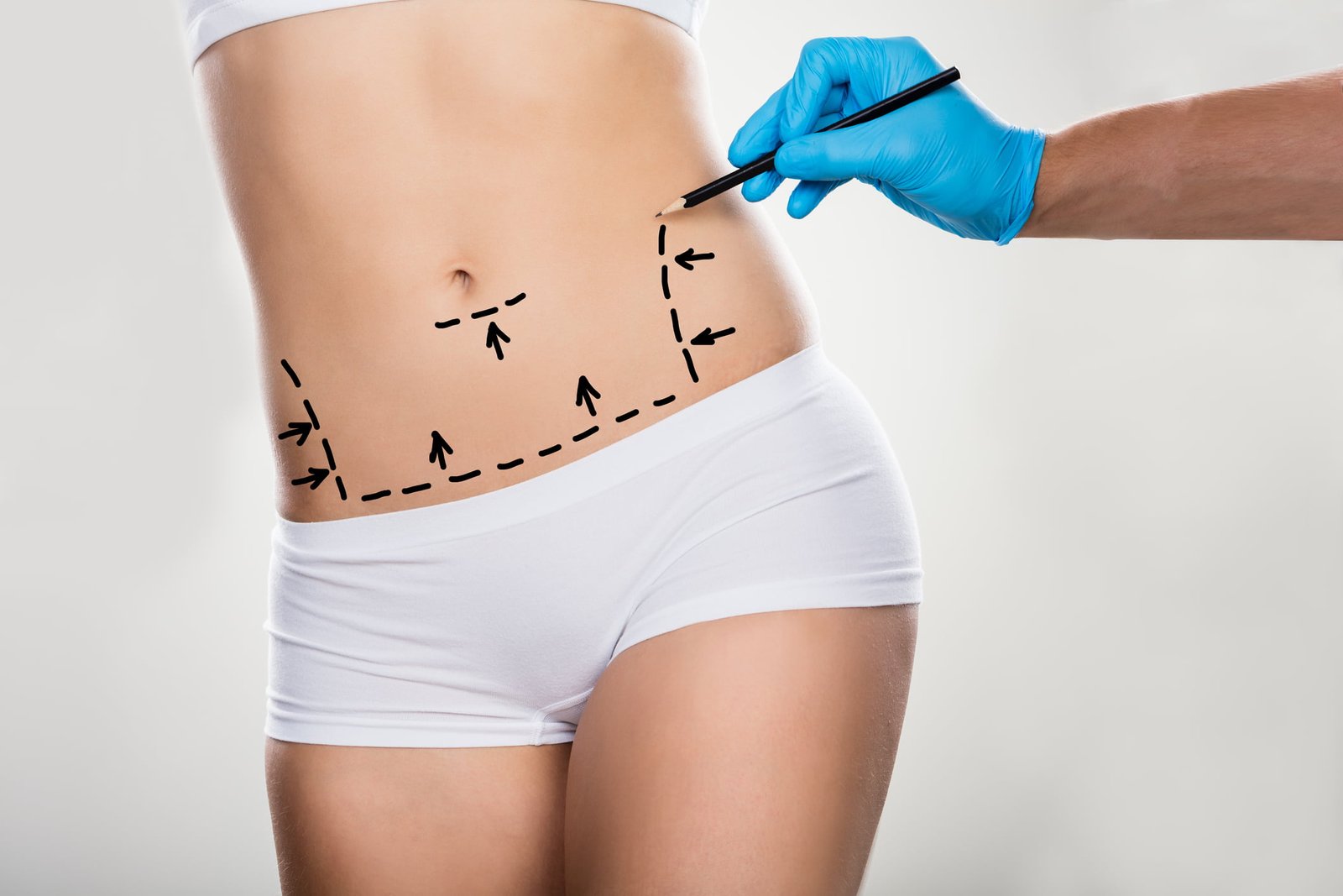 getting Tummy Tuck surgery lines drawn on the stomach