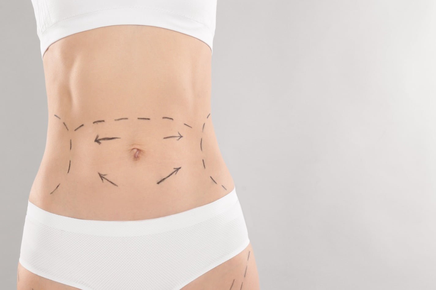 woman with surgery lines over her body 