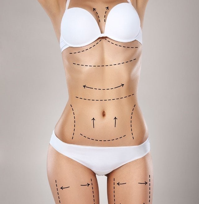 liposuction+in+miami