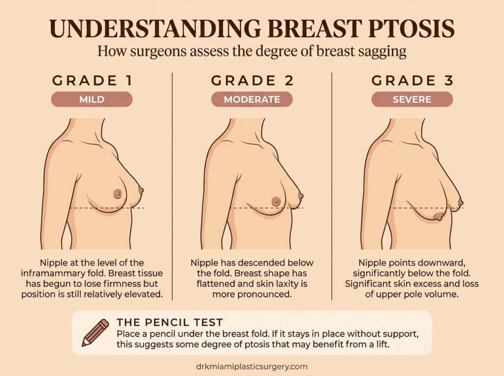 Diagram showing three grades of breast ptosis: mild, moderate, and severe
