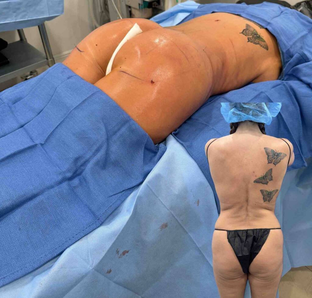 brazilian butt lift before and after