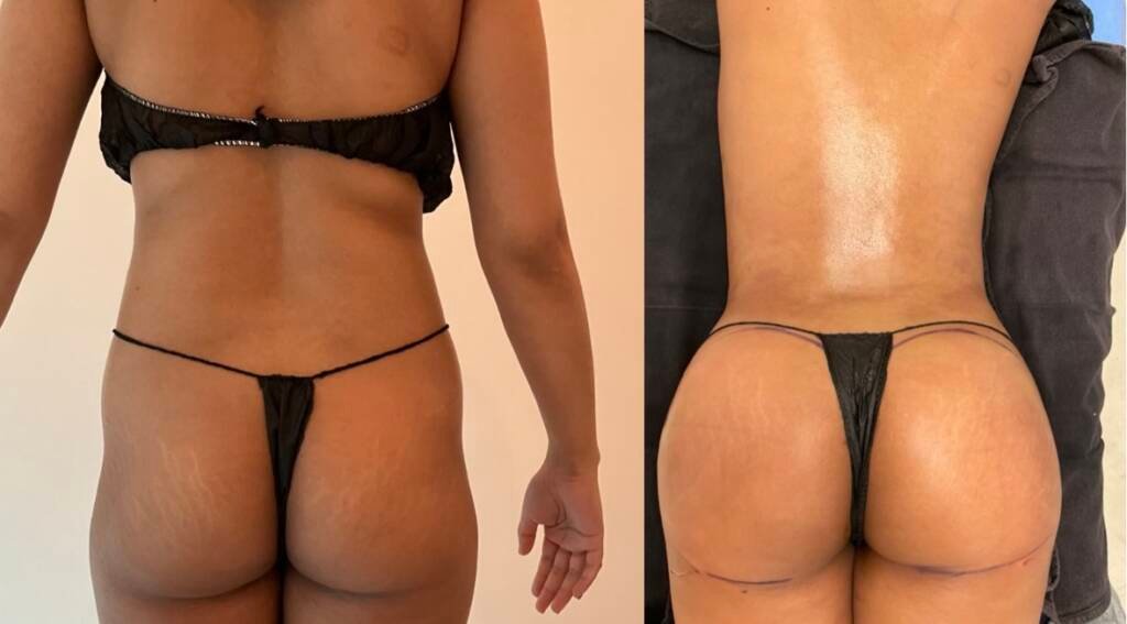 bbl before and after woman in miami